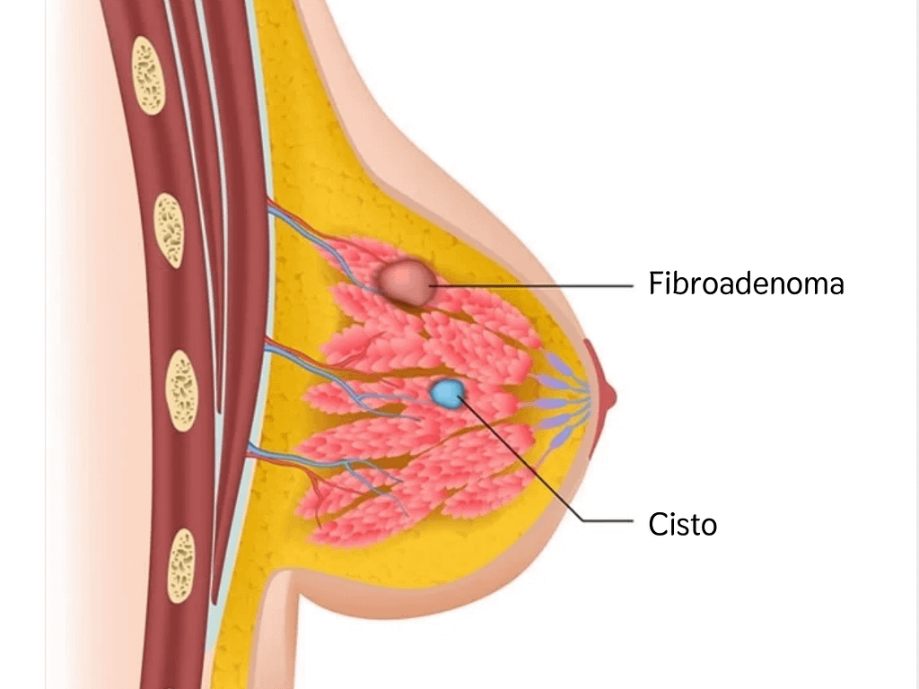 Dra-Karina-Belickas-mastologista-fibroadenoma-imagem